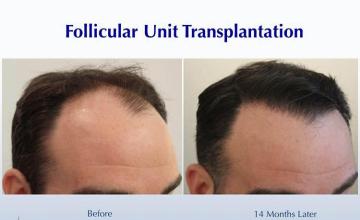 Hair restoration procedure after result images