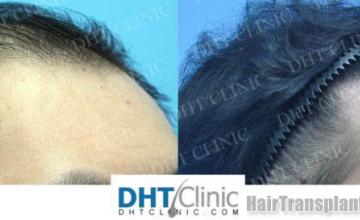 Hair transplantation procedure before and after results