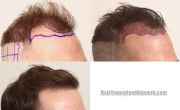 Hair transplantation procedure before and after results