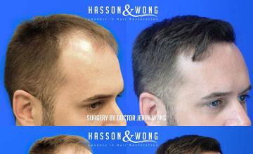 Hair transplantation procedure before and after results