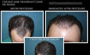 Top view before and after hair restoration