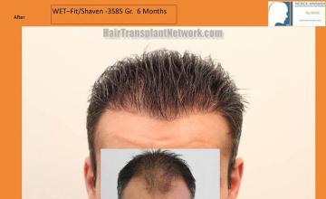 Hair transplantation surgery before and after photos