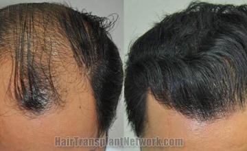 Hair transplantation surgery before and after photos