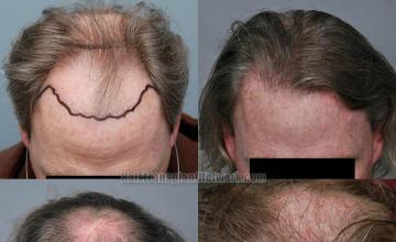 Hair restoration procedure before and after results