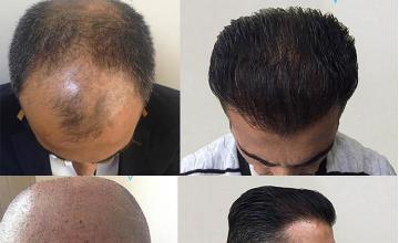 Hair transplantation surgery before and after pictures