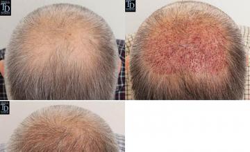 Hair restoration procedure before and after results