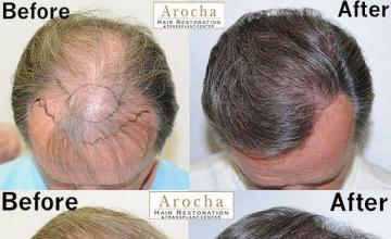 Hair restoration procedure before and after results