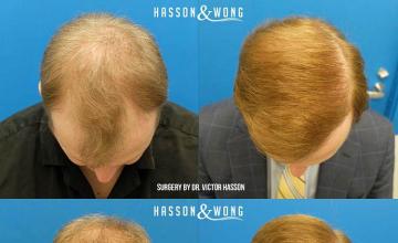 Hair transplantation surgery before and after pictures