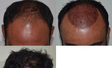 Hair transplantation surgery before and after photos