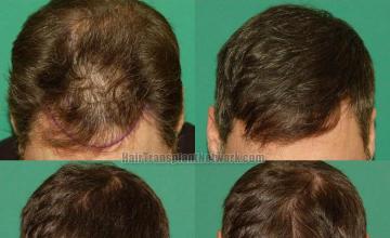 Hair restoration procedure before and after results