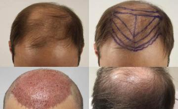 Hair restoration procedure before and after results