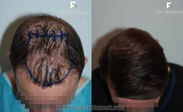 Hair restoration procedure before and after result photos