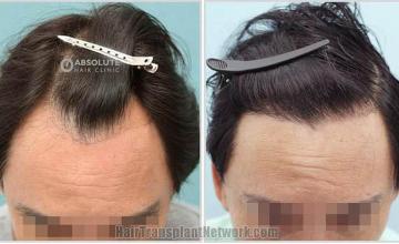 Front view - Before and after hair transplantation surgery