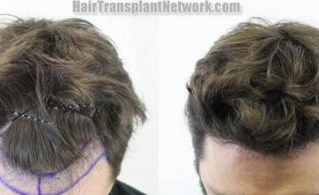 Hair transplantation surgery before and after images