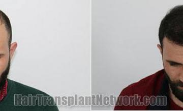 Before and after hair restoration procedure images