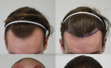 Hair transplantation surgery before and after images