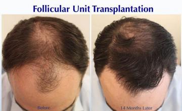 Hair restoration procedure before and after results