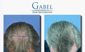 Hair transplantation surgery before and after images