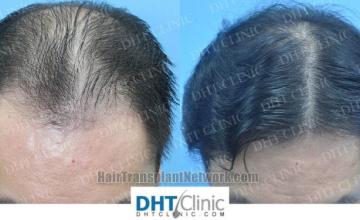 Before and after hair restoration procedure images