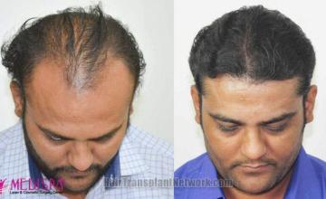 Hair transplantation surgery before and after images