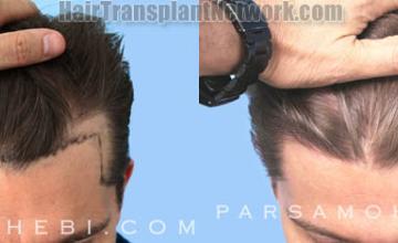 Hair transplantation surgery before and after images