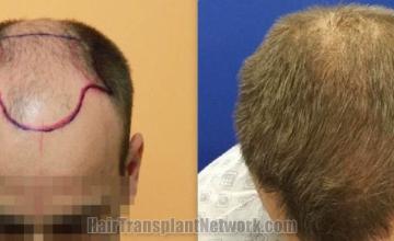 Hair transplantation surgery before and after images