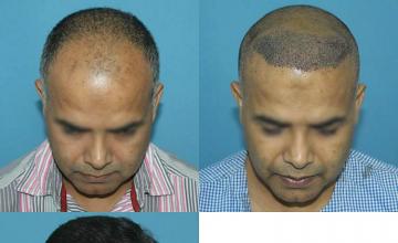 Before and after hair restoration procedure images