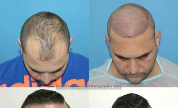 Hair transplantation surgery before and after images