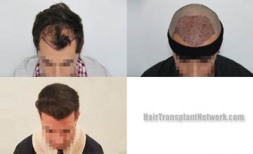 Before and after hair restoration procedure images