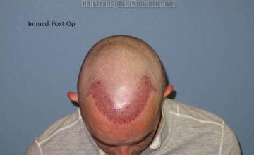 Hair transplantation surgery before and after pictures