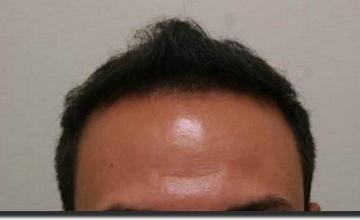 Hair restoration procedure results