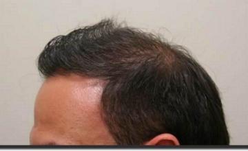 Hair restoration procedure results