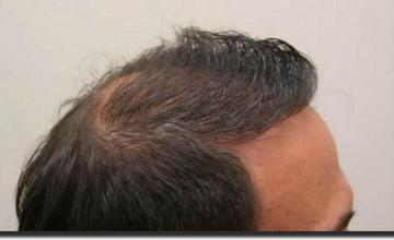 Hair restoration procedure results