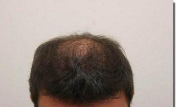 Hair restoration procedure results