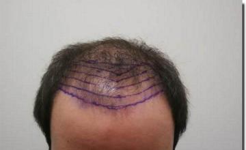 Hair restoration procedure results