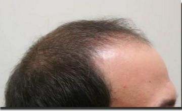 Hair restoration procedure results