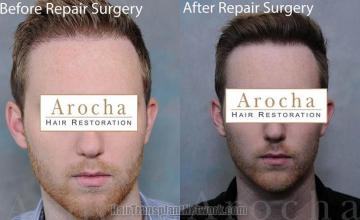 Hair restoration procedure before and after results