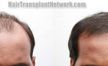 Before and after hair restoration procedure images