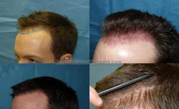 Left view - Before and after hair transplantation procedure