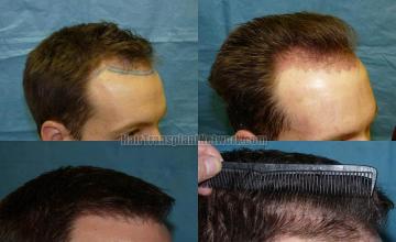 Hair restoration procedure results photographs