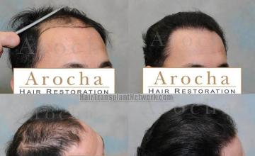 Right view - Before and after hair transplant session