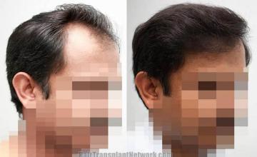 Hair transplantation surgery before and after pictures