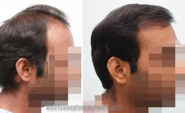 Hair transplantation surgery before and after photos