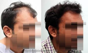 Surgical hair transplantation result photographs