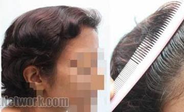 Hair transplantation surgery before and after images