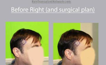 Hair transplantation procedure before and after results