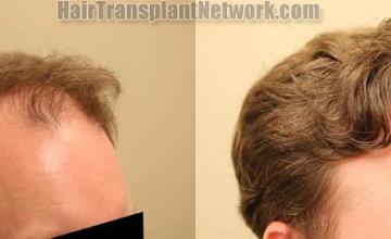 Hair transplantation surgery before and after images