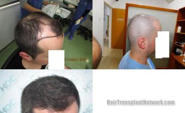 Hair restoration procedure results