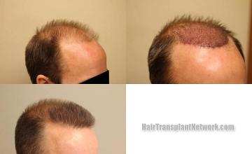 Hair transplantation procedure before and after results