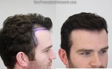 Hair transplantation procedure before and after results